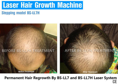 العلاج بالليزر منخفض المستوى لنمو الشعر